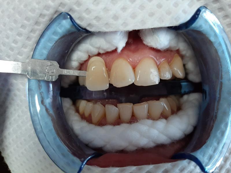 2-uzębienie-pacjenta-przed-zabiegiem dentystycznym