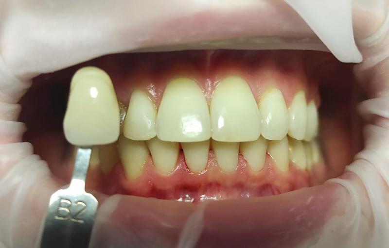 3-uzębienie-pacjenta-przed-zabiegiem dentystycznym