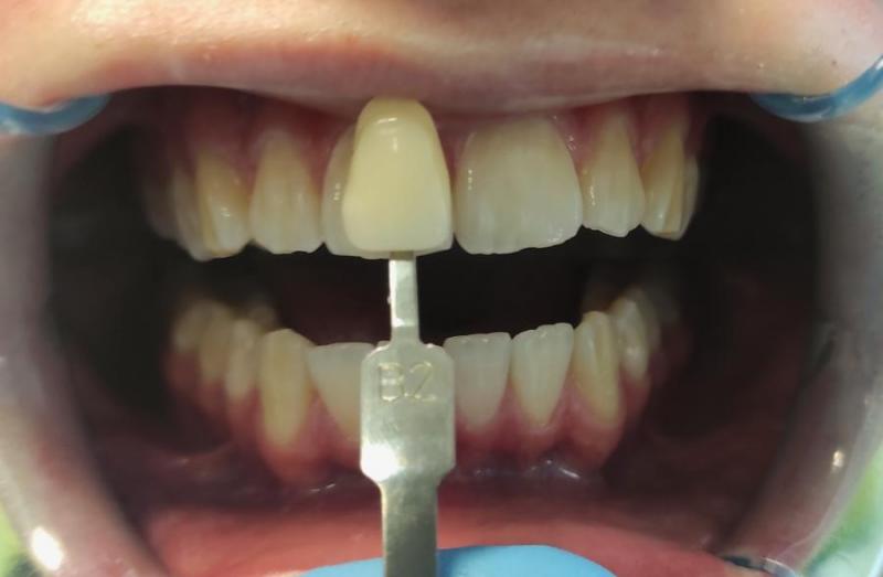 4-uzębienie-pacjenta-przed-zabiegiem dentystycznym