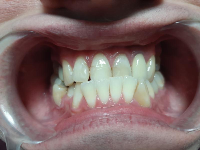 5-uzębienie-pacjenta-przed-zabiegiem dentystycznym